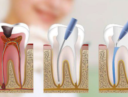 tratamiento de endodoncia en Lima