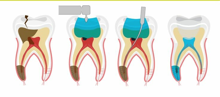 endodoncia diente dentista