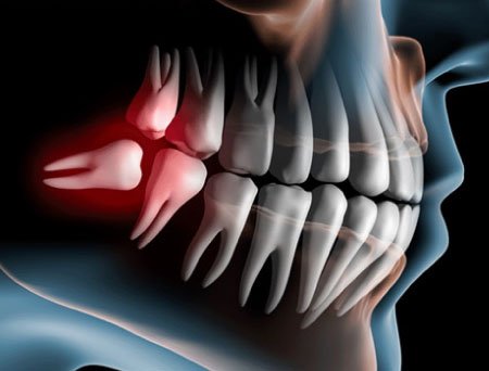 courses-01-free-img exodoncia lima